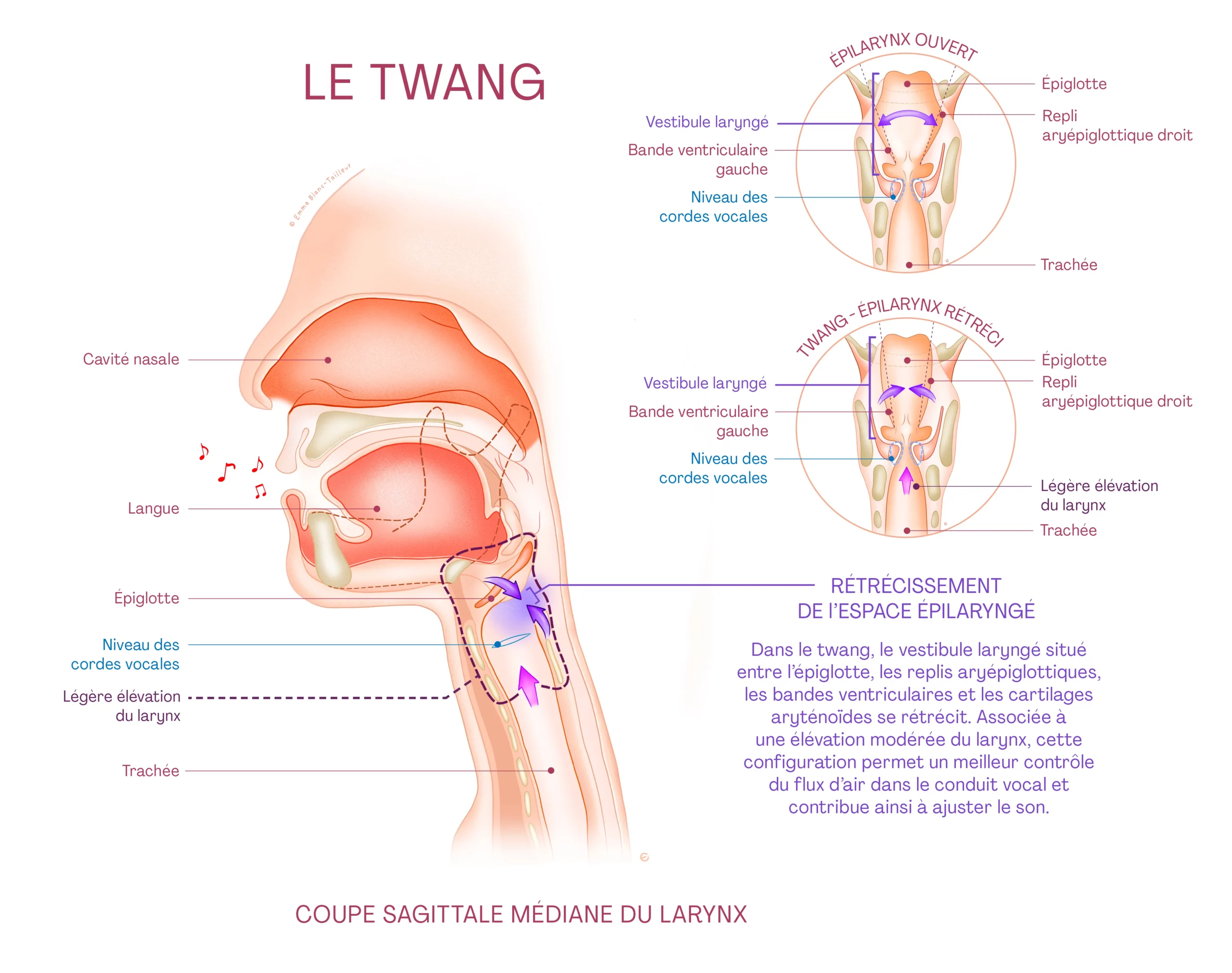Twang的解剖学图解 — 杓会厌括约肌收窄