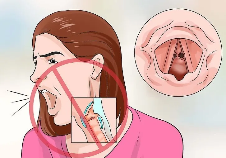 Vocal cord nodule detail
