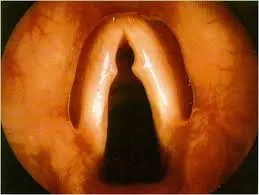 Vocal cord nodules — laryngoscopic view